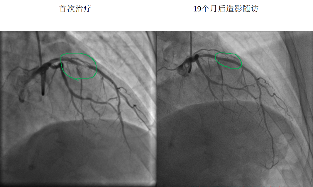 药物球囊治疗支架内再狭窄(图1)