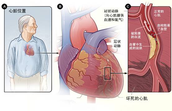 冠心病的起因是什么？(图1)